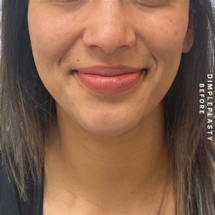 dimpleplasty after