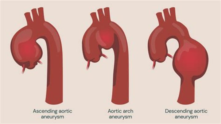 How Did He Die? Aortic Aneurysm