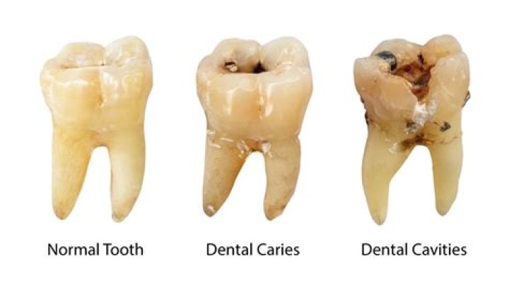 How Many Cavities Have You Had