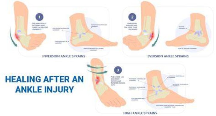 Is It Normal to Have a Sprained Ankle Without Swelling or Bruising?
