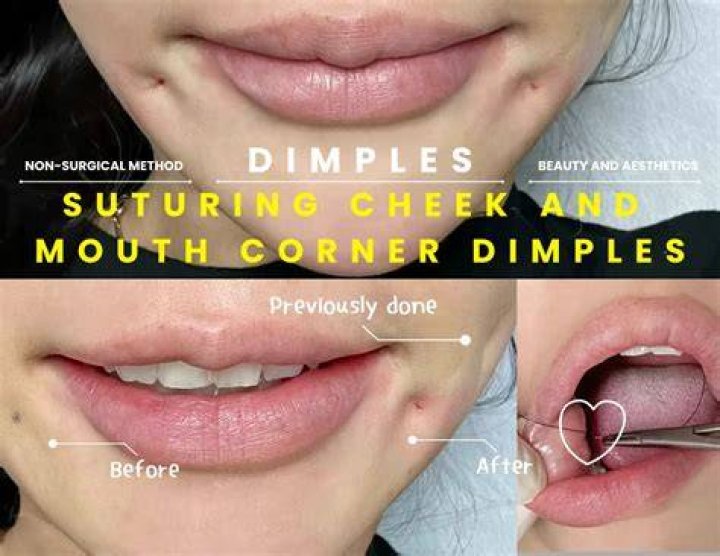 Mouth Corner Dimples Causes, How Common, How to Get HowChimp
