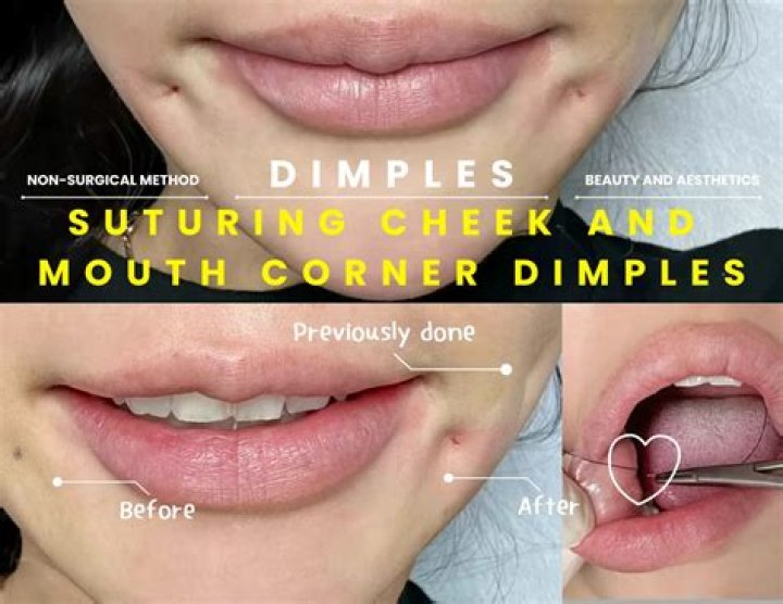Mouth Corner Dimples r/cosmeticsurgery