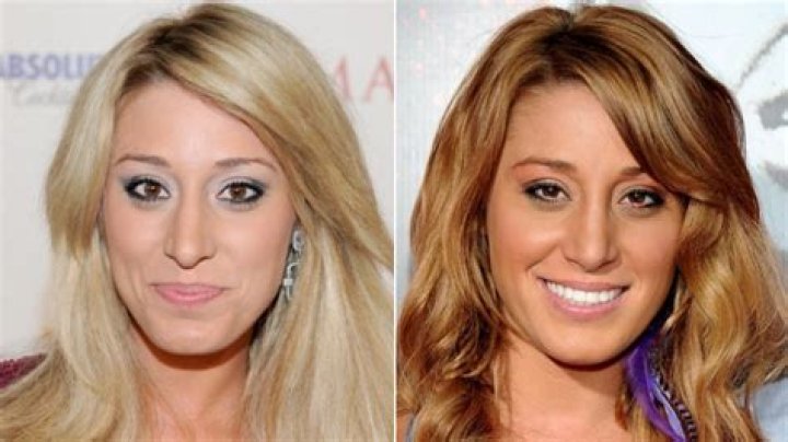 The Biggest Bachelor Plastic Surgery Transformations Explained