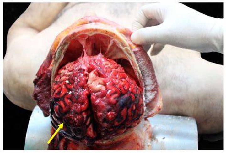Understanding The Deedee Autopsy: An In-Depth Analysis